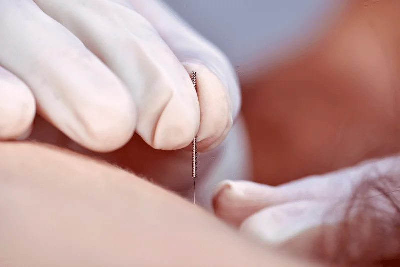 Dry Needling in Phoenix Medical Spa