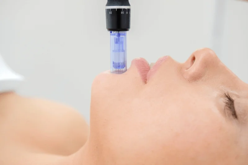 Microneedling in Phoenix Medical Spa