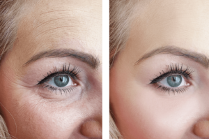 botox treatment before & after