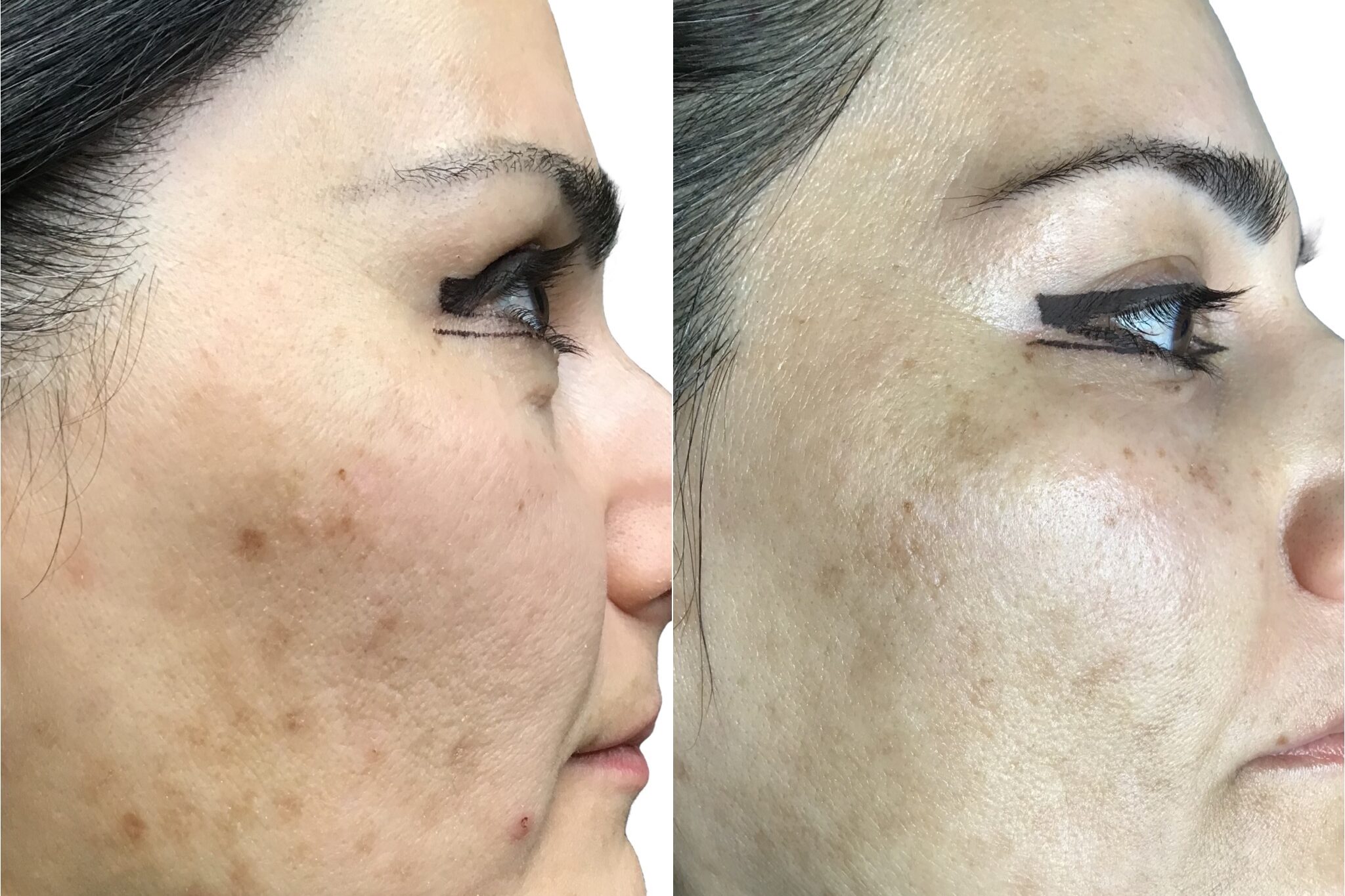 AnteAGE microneedling