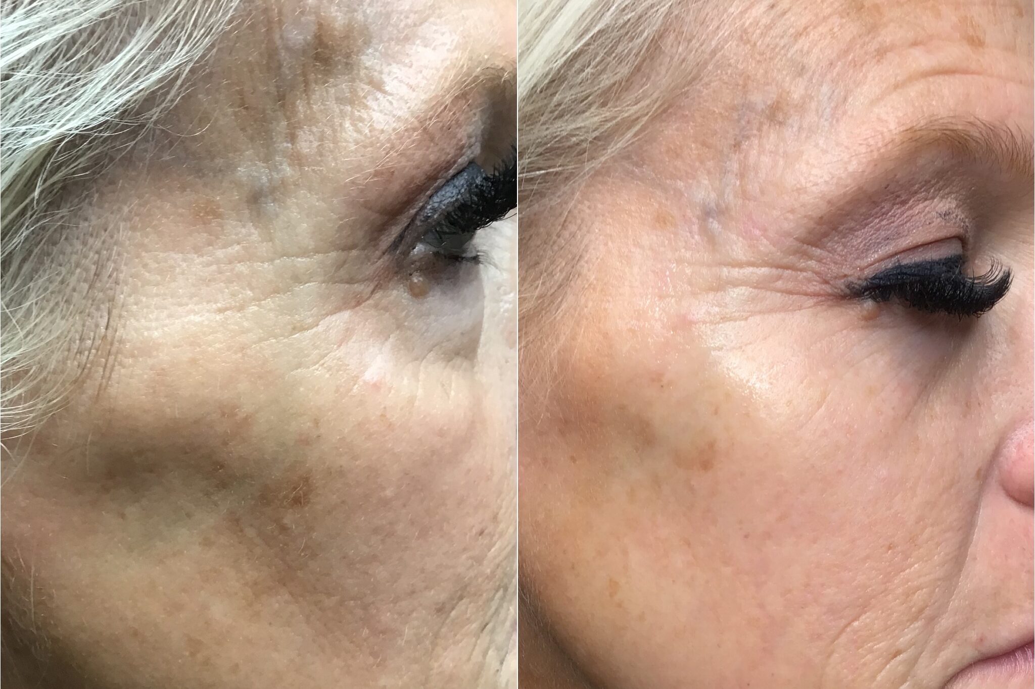 AnteAGE mnicroneedling