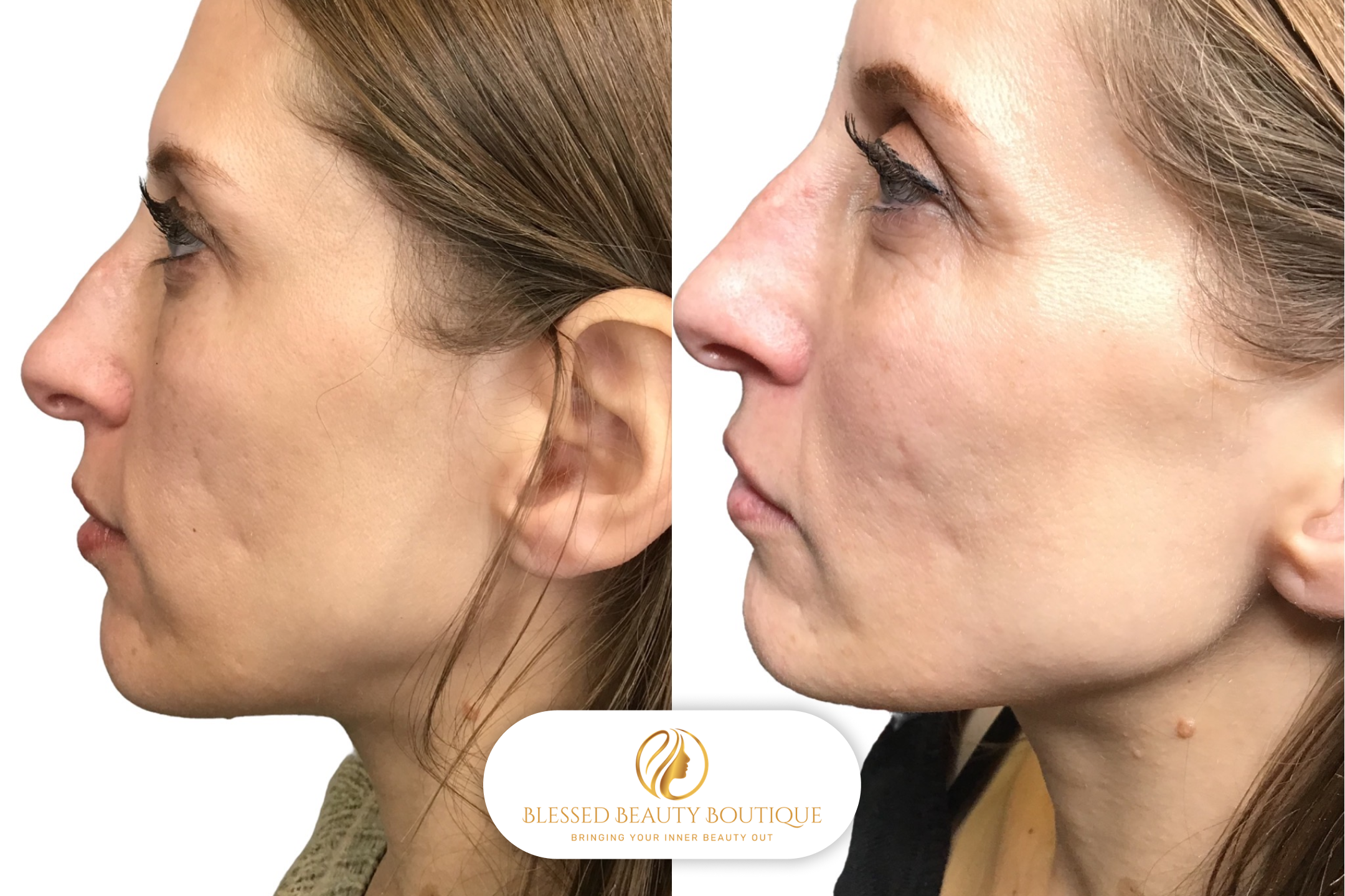 B&A Microneedling 1