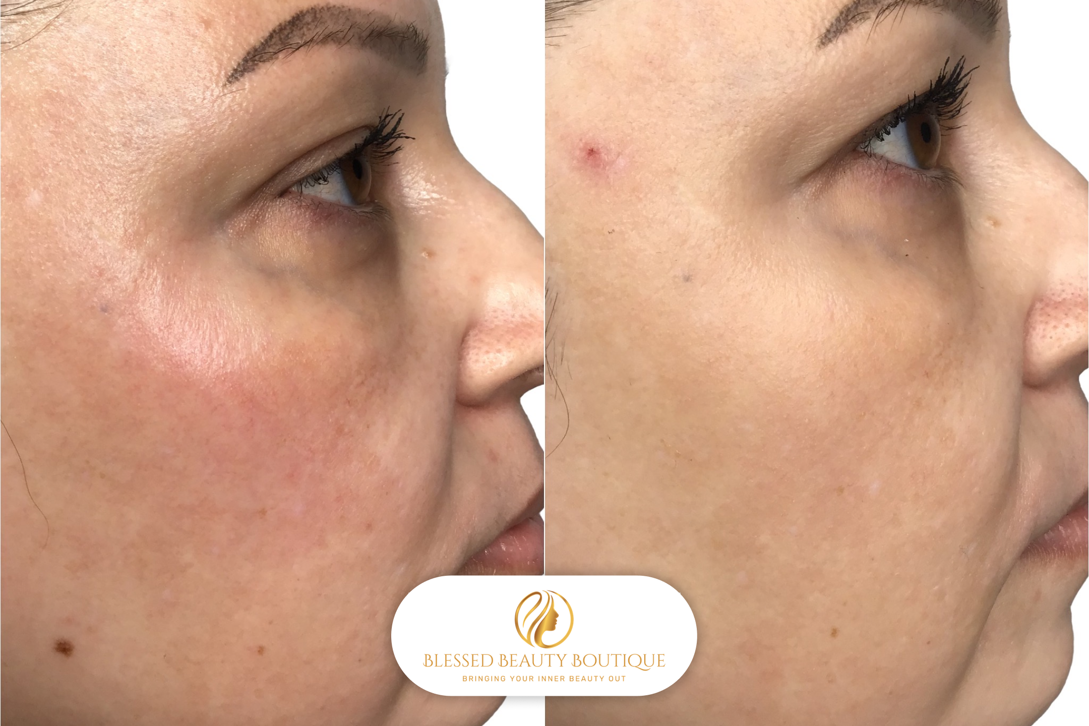 B&A Microneedling 2