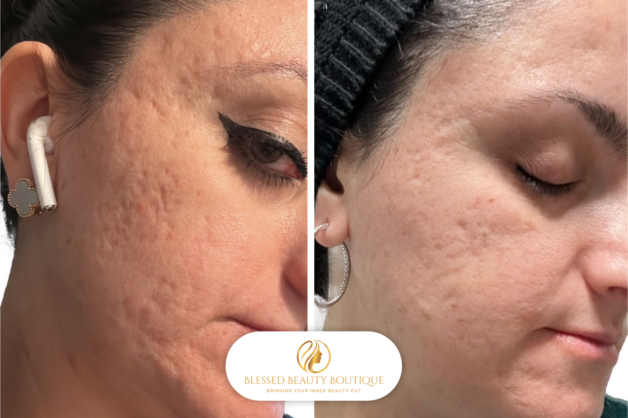 B&A Microneedling 3