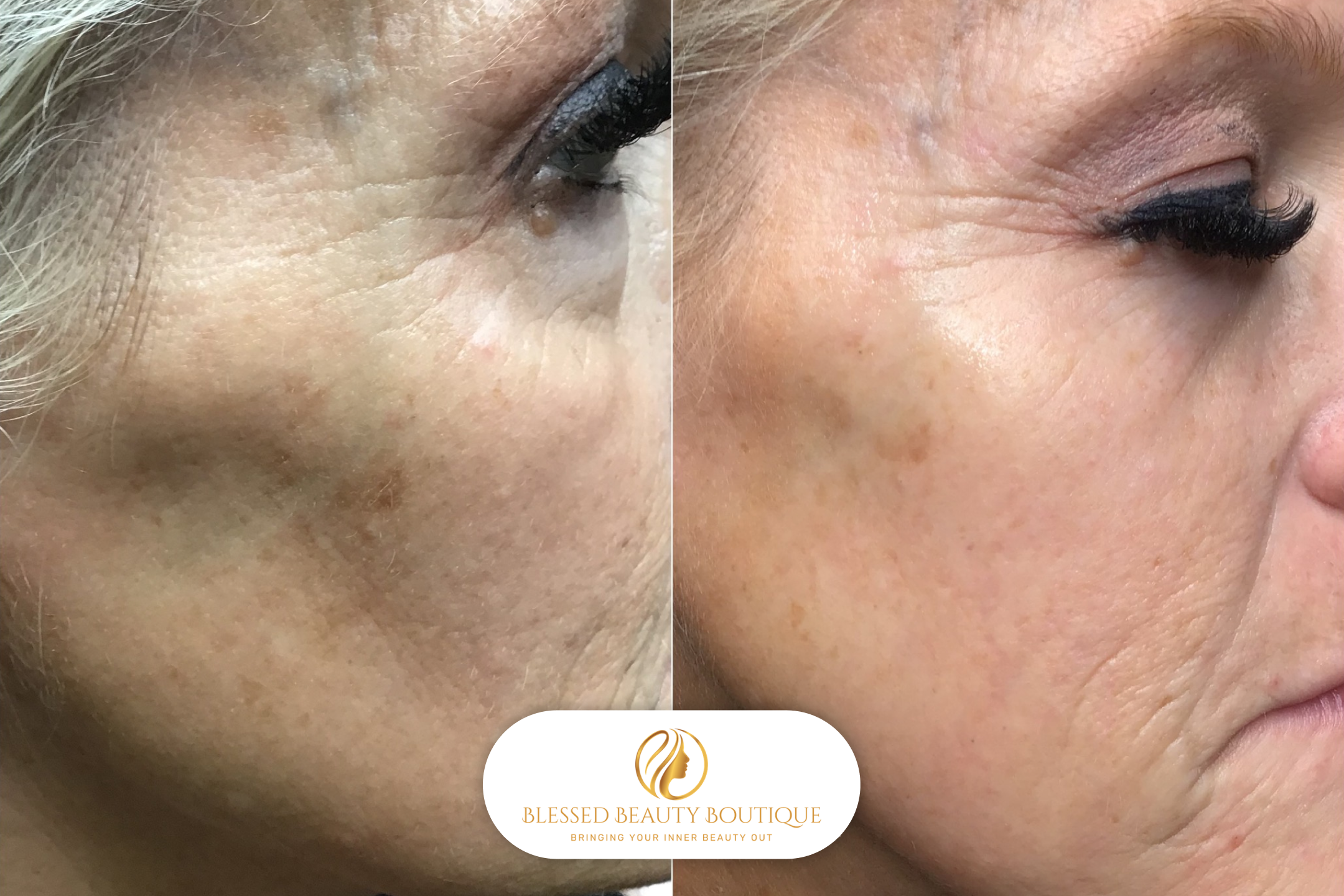 B&A Microneedling 4