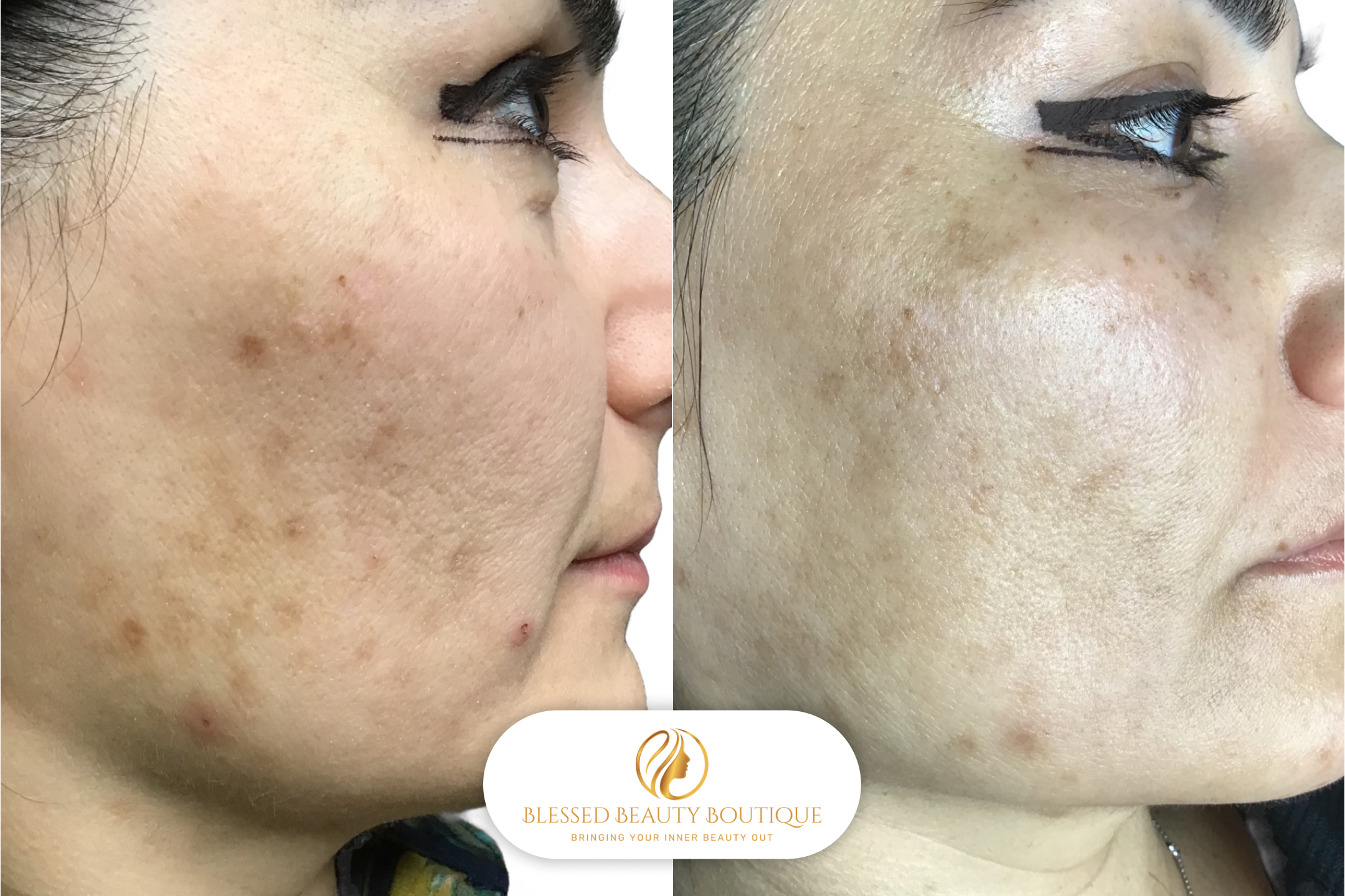 B&A Microneedling 5