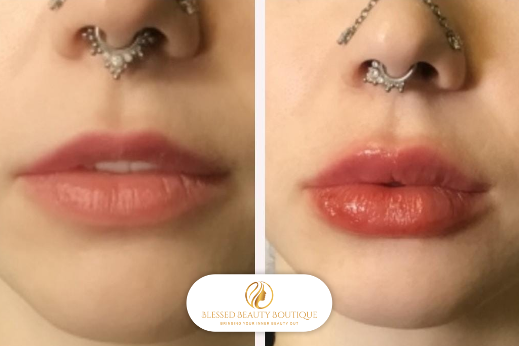 Lip Fillers Near Me in Phoenix AZ