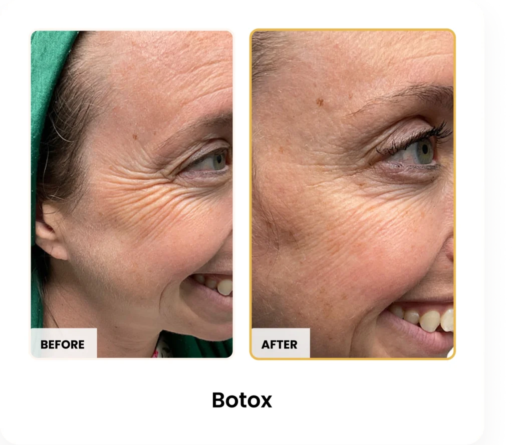 Botox before and after results at Blessed Beauty Boutique in Phoenix, Arizona