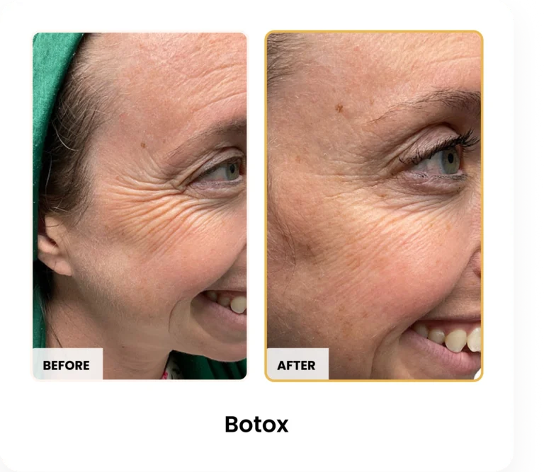 Botox before and after results at Blessed Beauty Boutique in Phoenix, Arizona