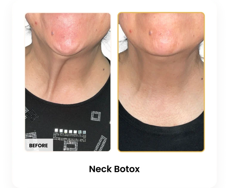 Neck Botox before and after results at Blessed Beauty Boutique in Phoenix, Arizona