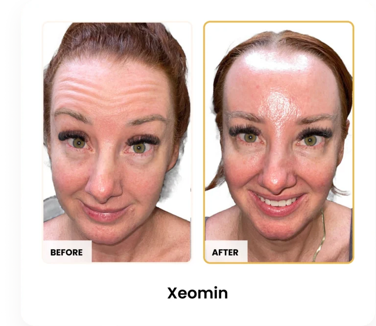Xeomin before and after results at Blessed Beauty Boutique in Phoenix, Arizona