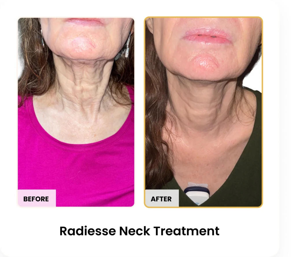 Radiesse Neck Treatment before and after results at Blessed Beauty Boutique in Phoenix, Arizona
