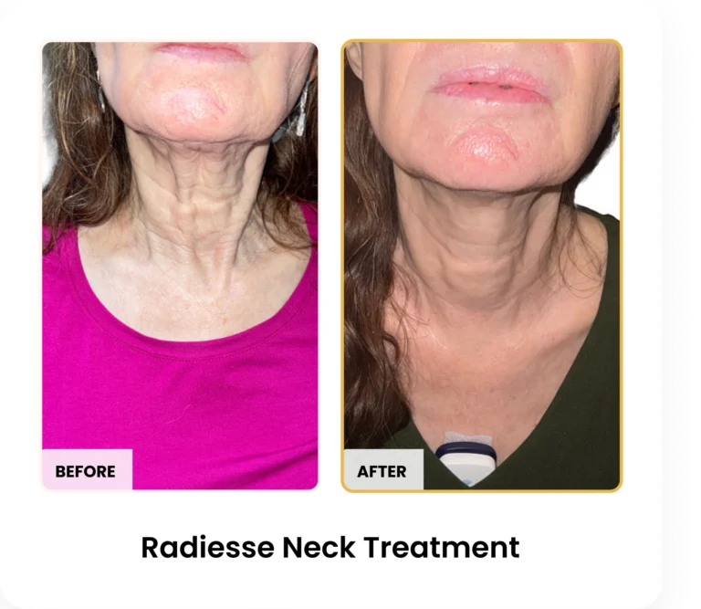Radiesse Neck Treatment before and after results at Blessed Beauty Boutique in Phoenix, Arizona