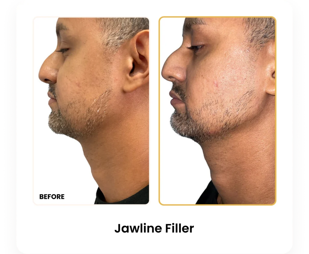 Jawline Filler before and after results at Blessed Beauty Boutique in Phoenix, Arizona