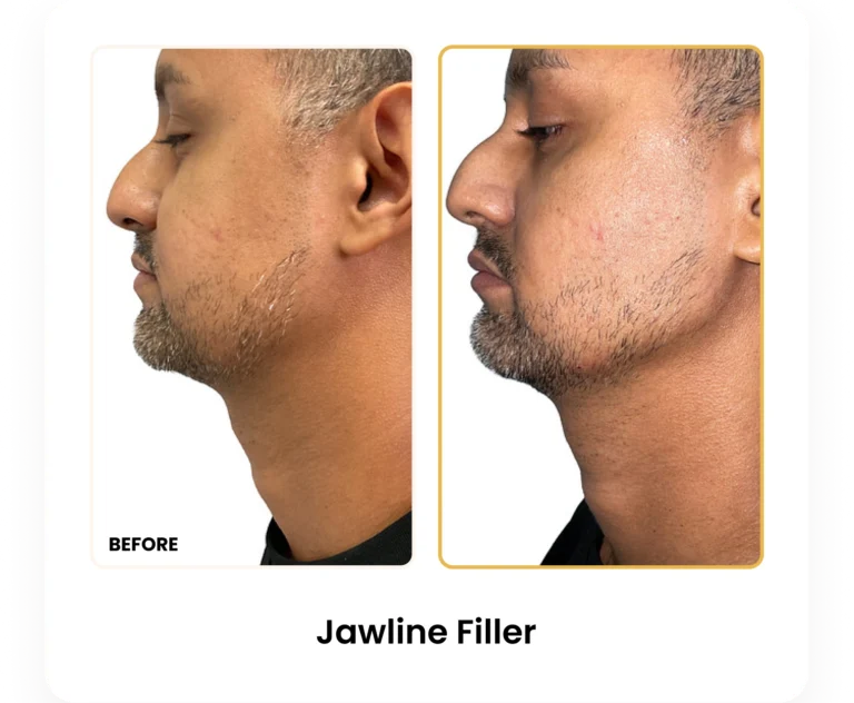 Jawline Filler before and after results at Blessed Beauty Boutique in Phoenix, Arizona