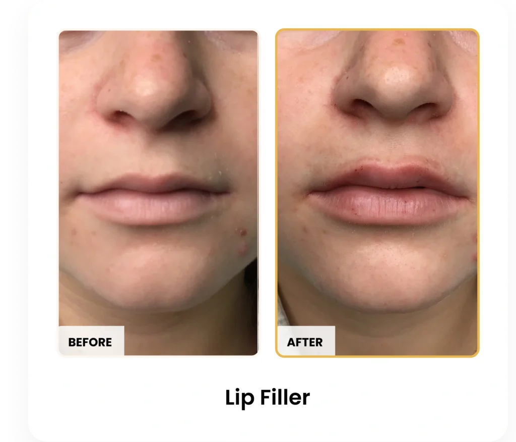 Lip Filler before and after results at Blessed Beauty Boutique in Phoenix, Arizona