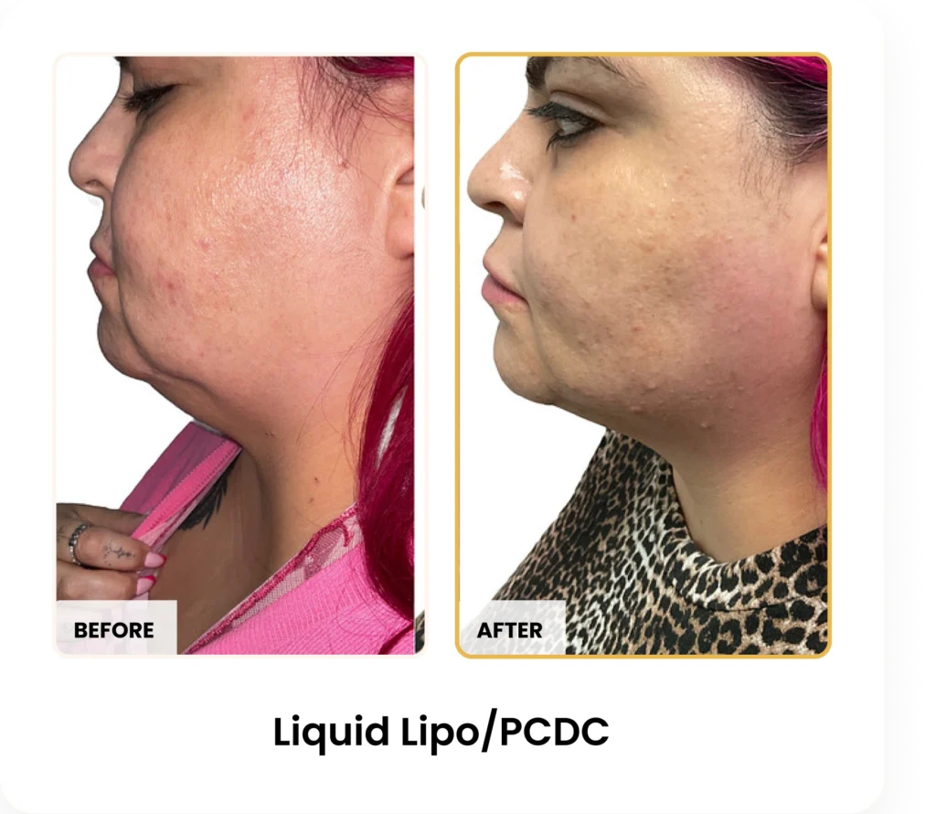 Liquid Lipo PCDC before and after results at Blessed Beauty Boutique in Phoenix, Arizona