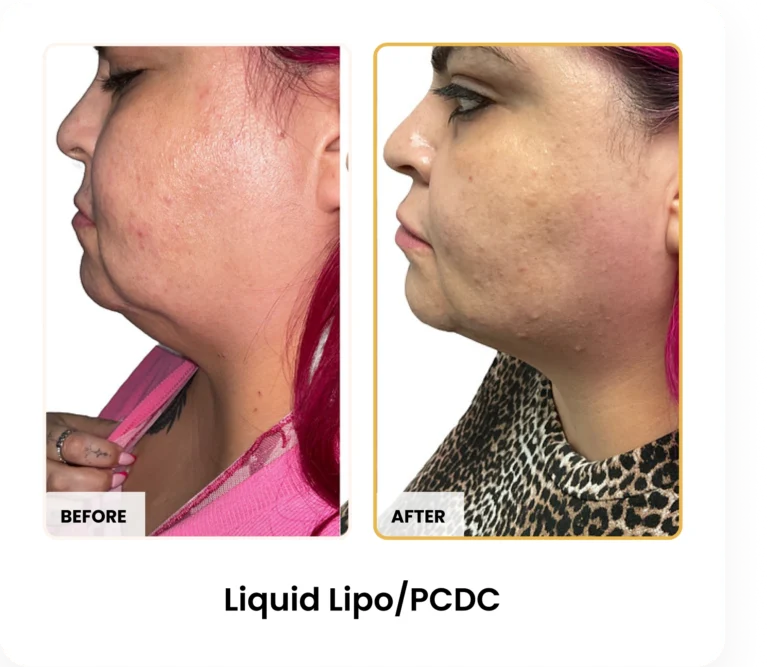 Liquid Lipo PCDC before and after results at Blessed Beauty Boutique in Phoenix, Arizona