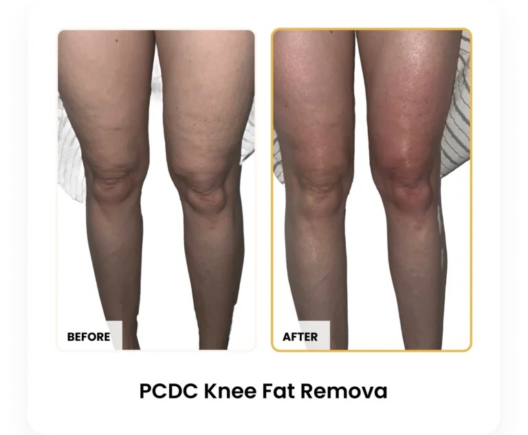 PCDC Knee Fat Removal before and after results at Blessed Beauty Boutique in Phoenix, Arizona