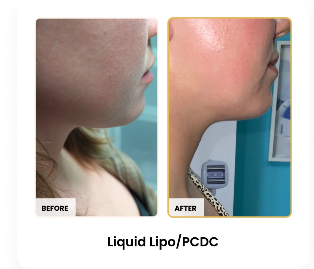 Liquid Lipo PCDC before and after results at Blessed Beauty Boutique in Phoenix, Arizona