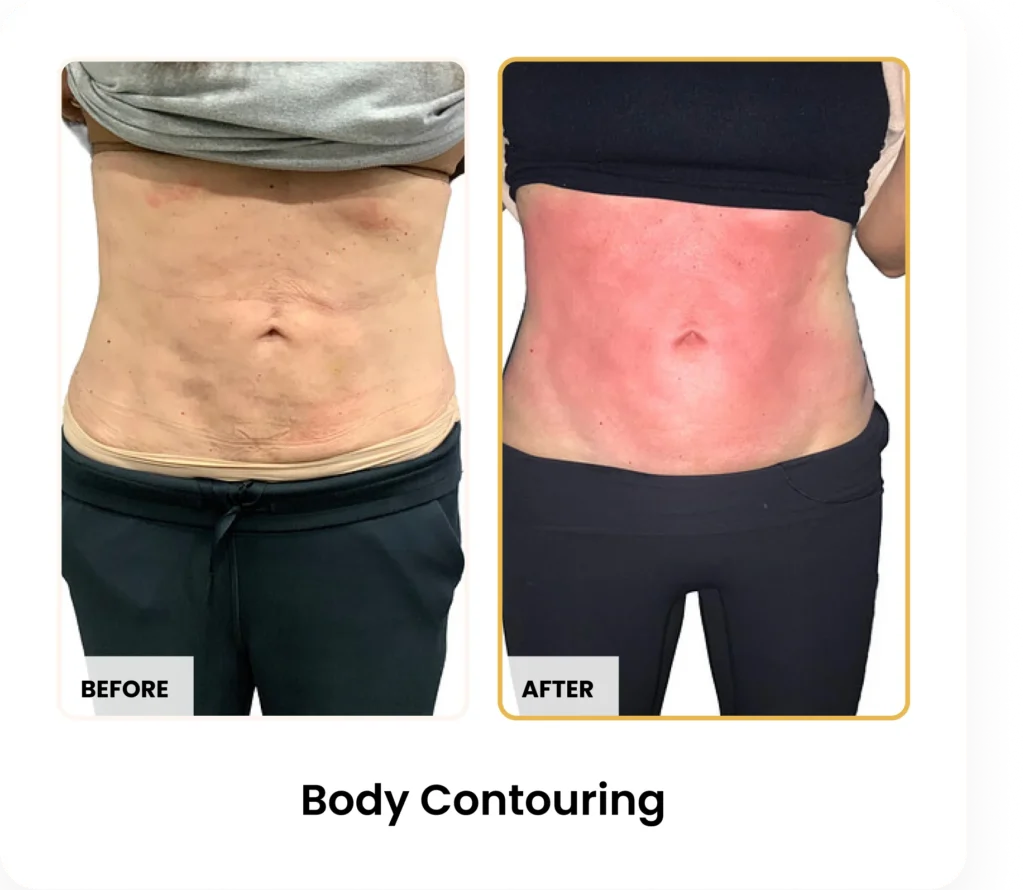 T-Shape 2 Body Contouring before and after results at Blessed Beauty Boutique in Phoenix, Arizona