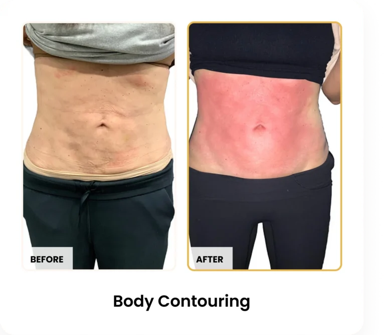 T-Shape 2 Body Contouring before and after results at Blessed Beauty Boutique in Phoenix, Arizona