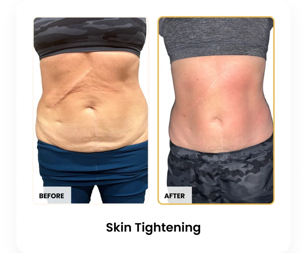 T-Shape 2 Skin Tightening before and after results at Blessed Beauty Boutique in Phoenix, Arizona