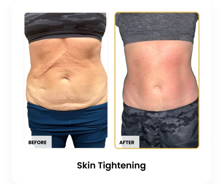 T-Shape 2 Skin Tightening before and after results at Blessed Beauty Boutique in Phoenix, Arizona