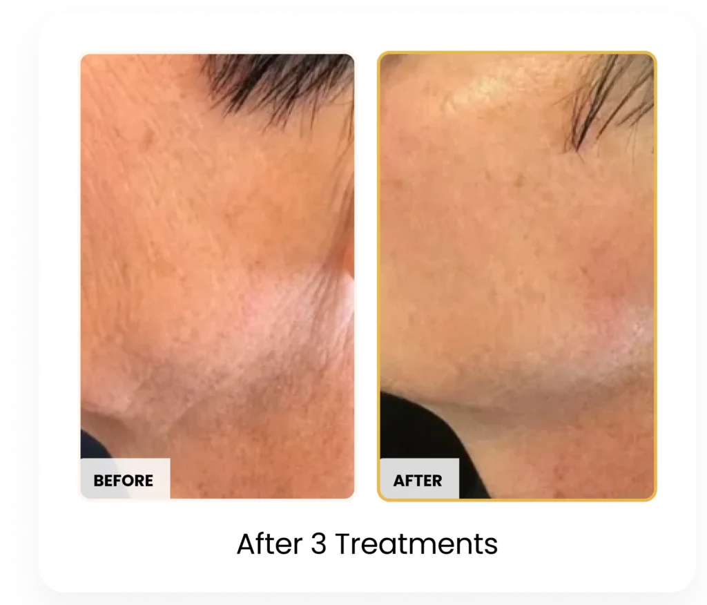 T-Shape 2 Body Contouring After 3 Treatments before and after results at Blessed Beauty Boutique in Phoenix, Arizona