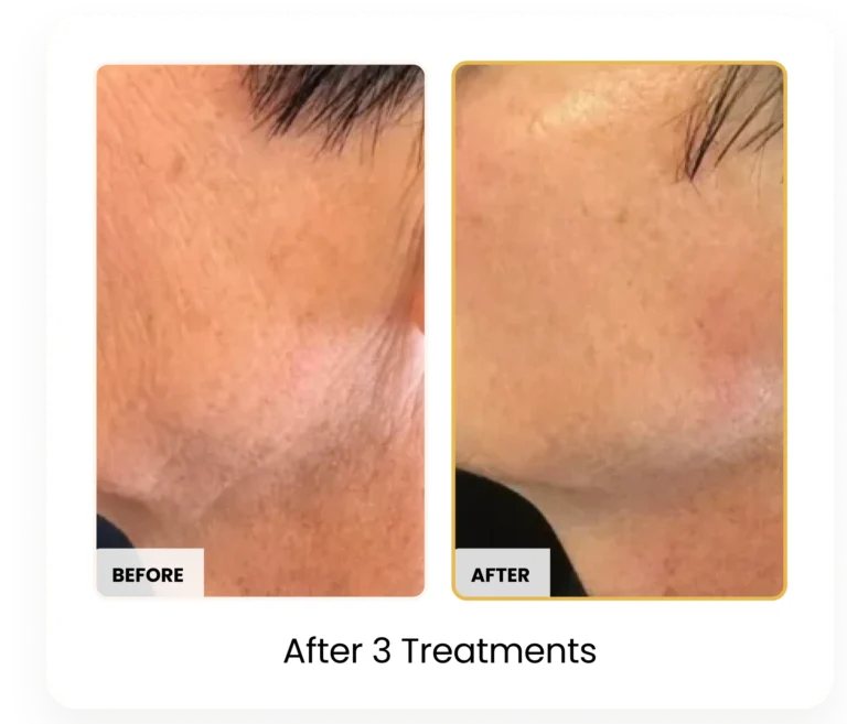 T-Shape 2 Body Contouring After 3 Treatments before and after results at Blessed Beauty Boutique in Phoenix, Arizona