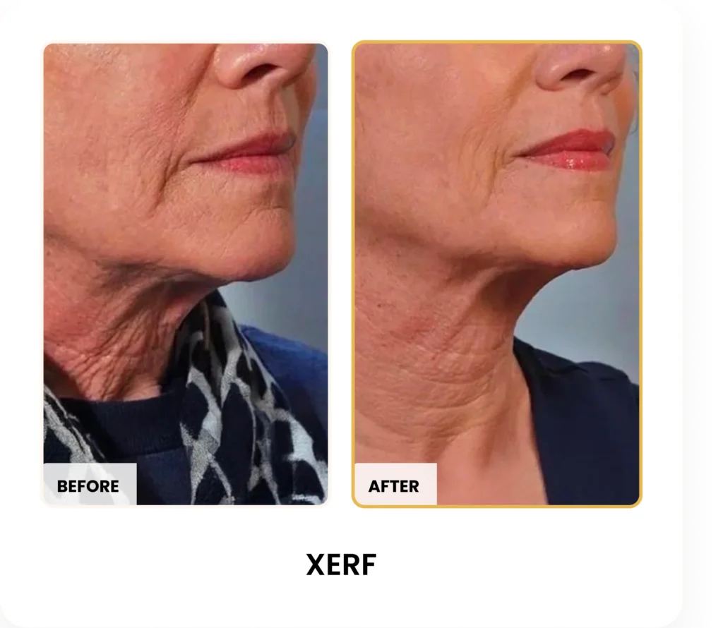 XERF Skin Tightening before and after results at Blessed Beauty Boutique in Phoenix, Arizona