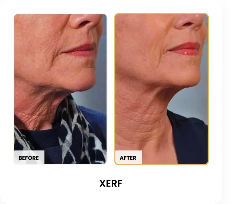 XERF Skin Tightening before and after results at Blessed Beauty Boutique in Phoenix, Arizona