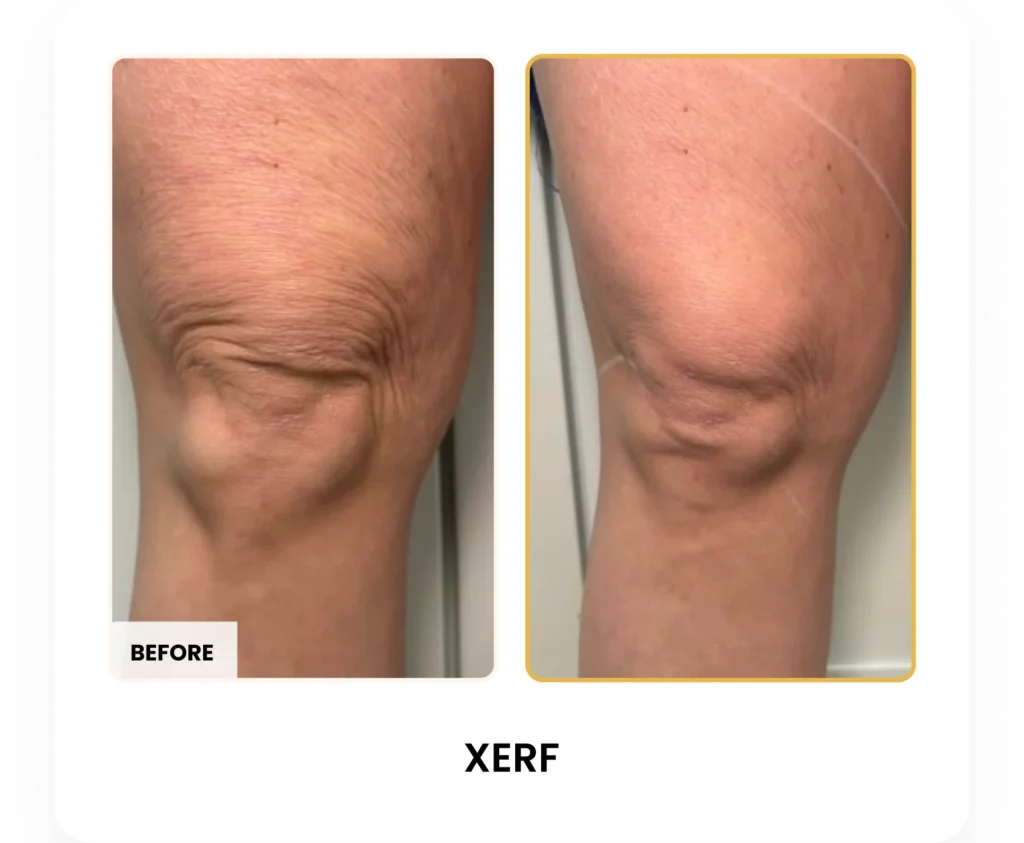 XERF Skin Tightening before and after results at Blessed Beauty Boutique in Phoenix, Arizona