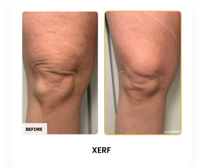 XERF Skin Tightening before and after results at Blessed Beauty Boutique in Phoenix, Arizona