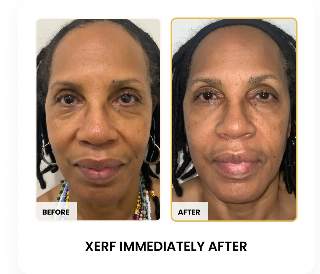 XERF Immediately After Treatment before and after results at Blessed Beauty Boutique in Phoenix, Arizona