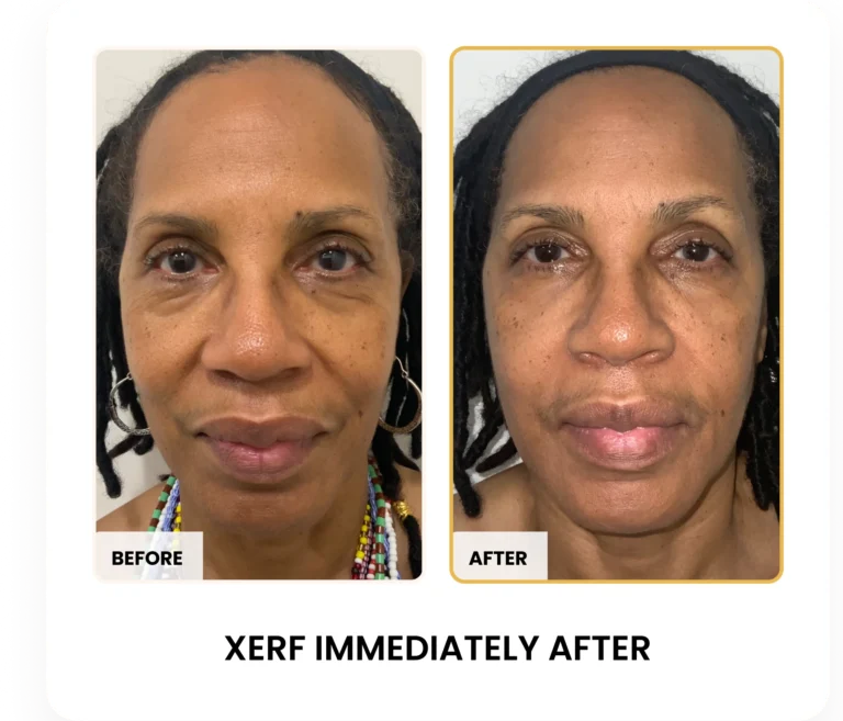 XERF Immediately After Treatment before and after results at Blessed Beauty Boutique in Phoenix, Arizona