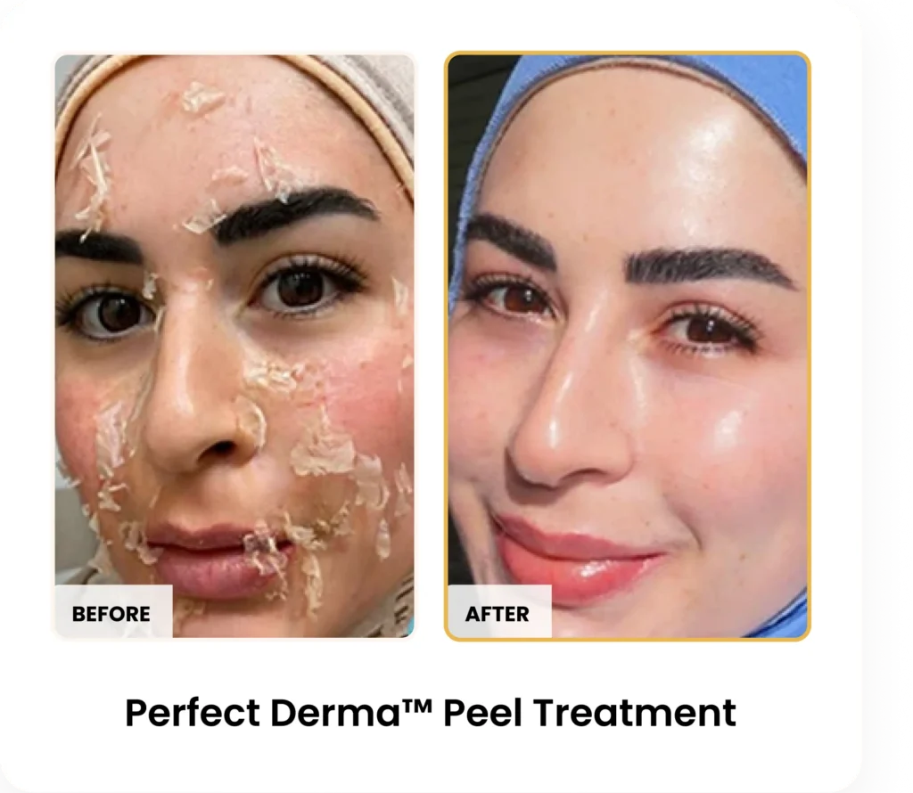 Perfect Derma Peel before and after results at Blessed Beauty Boutique in Phoenix, Arizona