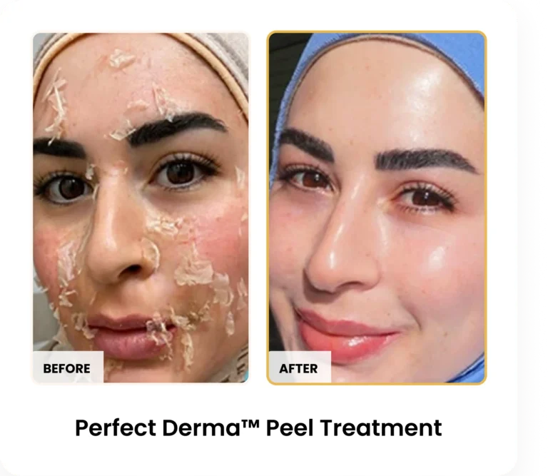 Perfect Derma Peel before and after results at Blessed Beauty Boutique in Phoenix, Arizona