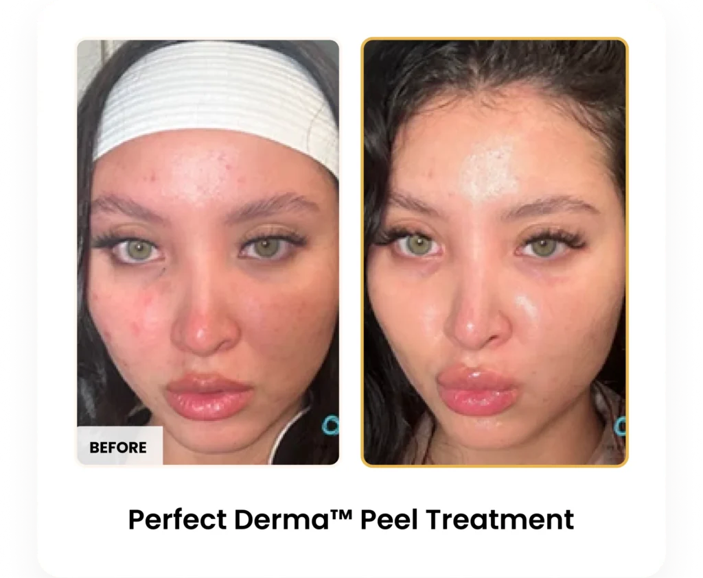 Perfect Derma Peel before and after results at Blessed Beauty Boutique in Phoenix, Arizona