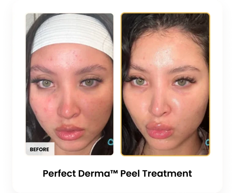 Perfect Derma Peel before and after results at Blessed Beauty Boutique in Phoenix, Arizona