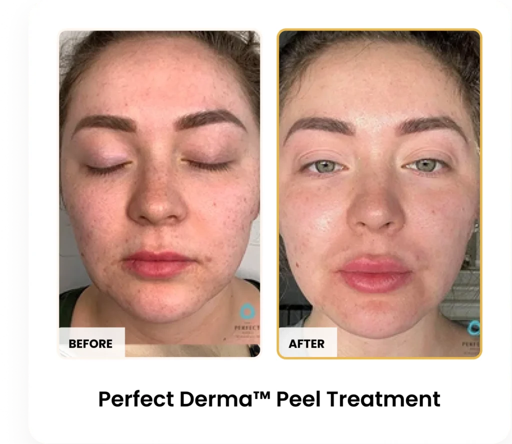 Perfect Derma Peel before and after results at Blessed Beauty Boutique in Phoenix, Arizona