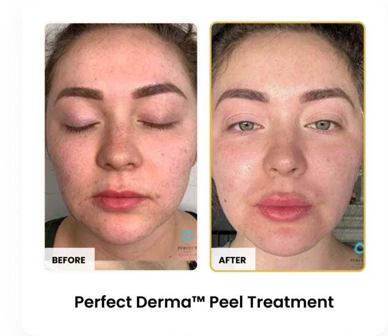 Perfect Derma Peel before and after results at Blessed Beauty Boutique in Phoenix, Arizona