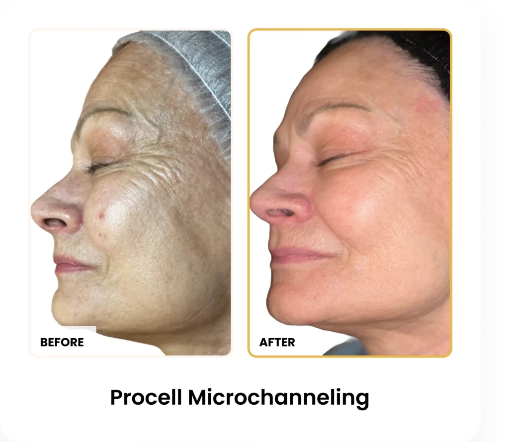ProCell Microchanneling before and after results at Blessed Beauty Boutique in Phoenix, Arizona