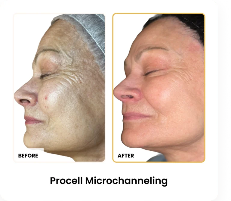 ProCell Microchanneling before and after results at Blessed Beauty Boutique in Phoenix, Arizona