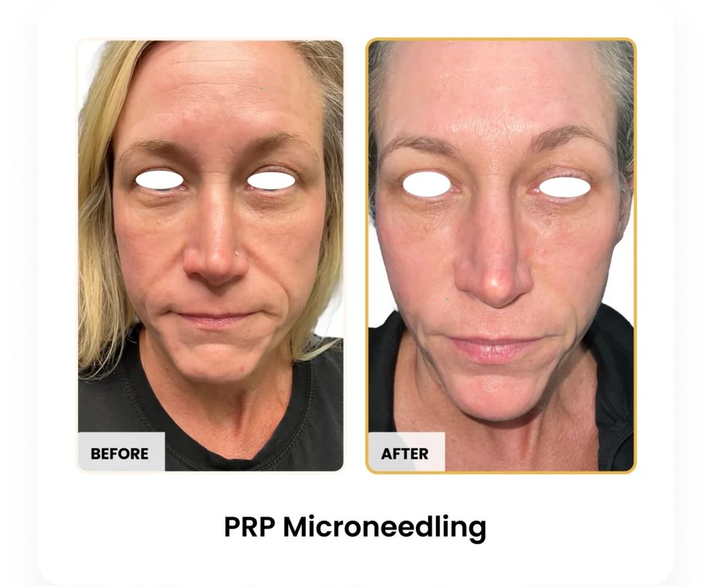 PRP Microneedling before and after results at Blessed Beauty Boutique in Phoenix, Arizona