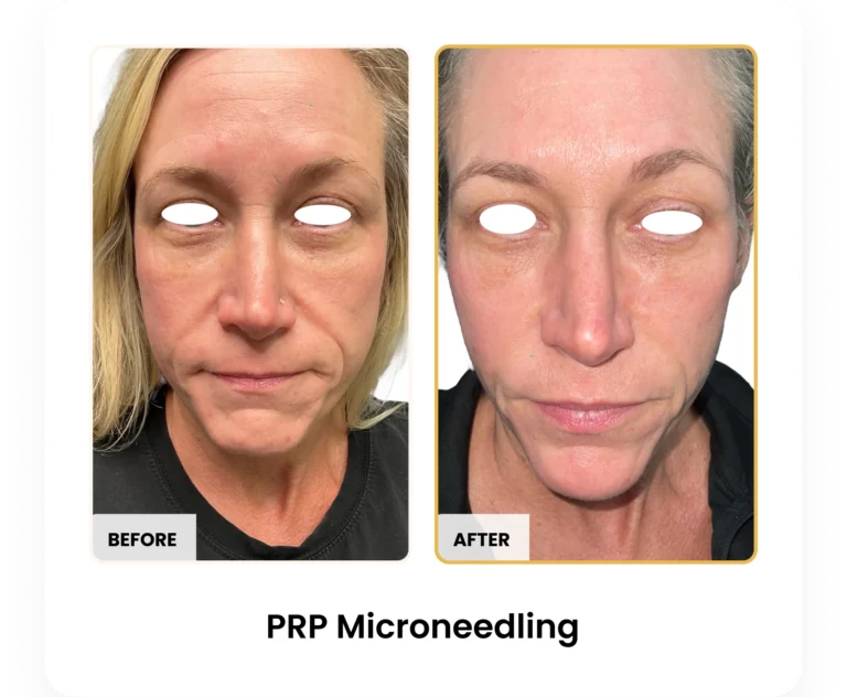 PRP Microneedling before and after results at Blessed Beauty Boutique in Phoenix, Arizona