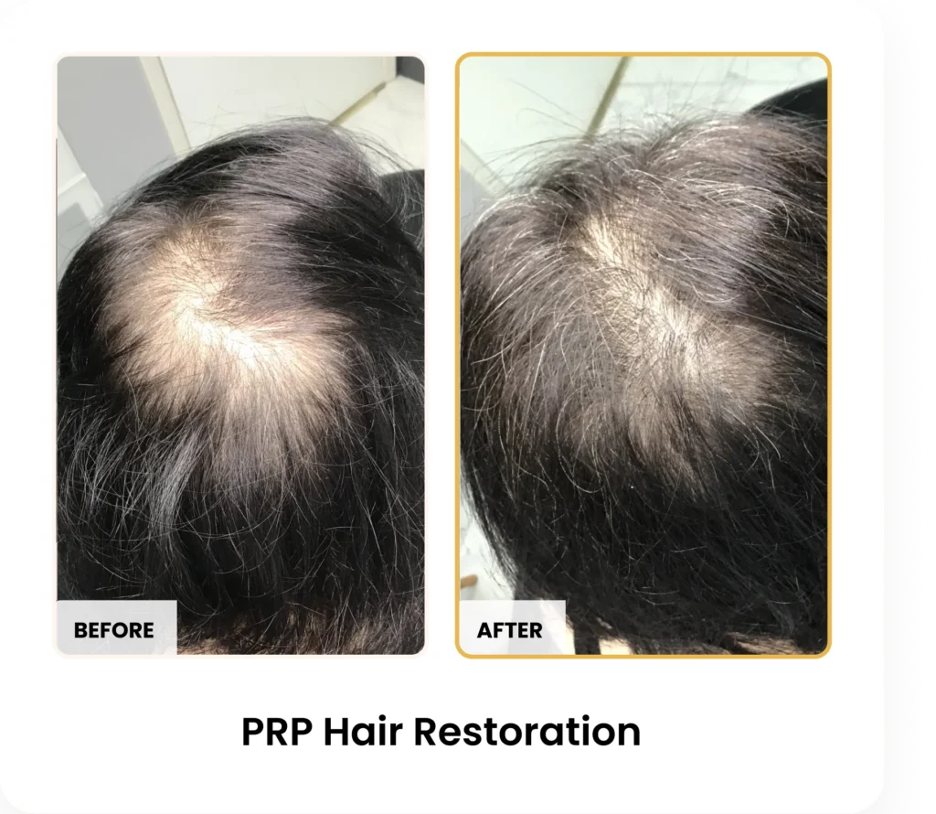 PRP Hair Restoration before and after results at Blessed Beauty Boutique in Phoenix, Arizona