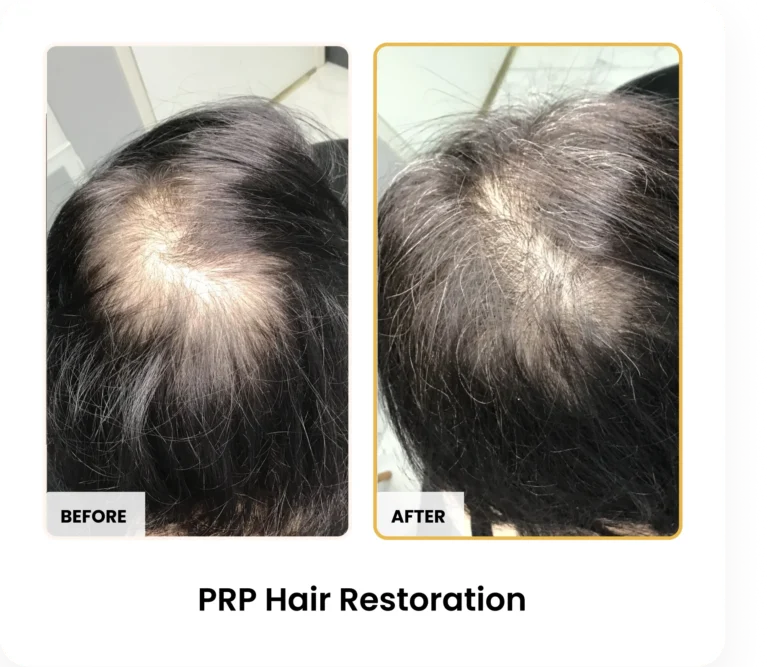 PRP Hair Restoration before and after results at Blessed Beauty Boutique in Phoenix, Arizona