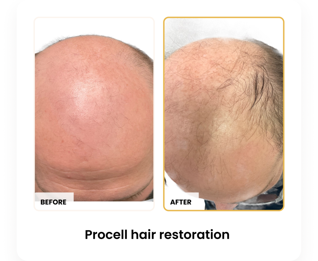 ProCell Hair Restoration before and after results at Blessed Beauty Boutique in Phoenix, Arizona