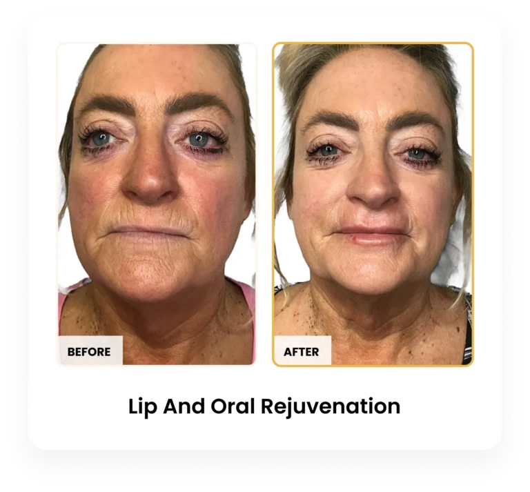 Lip and Oral Rejuvenation before and after results at Blessed Beauty Boutique in Phoenix, Arizona